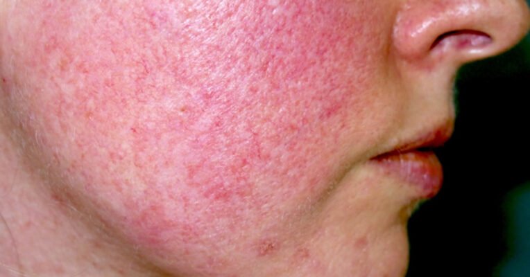 Ефективні методи лікування куперозу: як позбутися проблеми