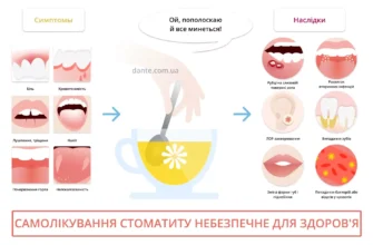 Ефективні методи лікування стоматиту: поради і рекомендації