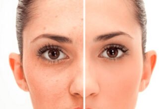 Ефективні методи позбавлення від шрамів після акне: поради та рекомендації