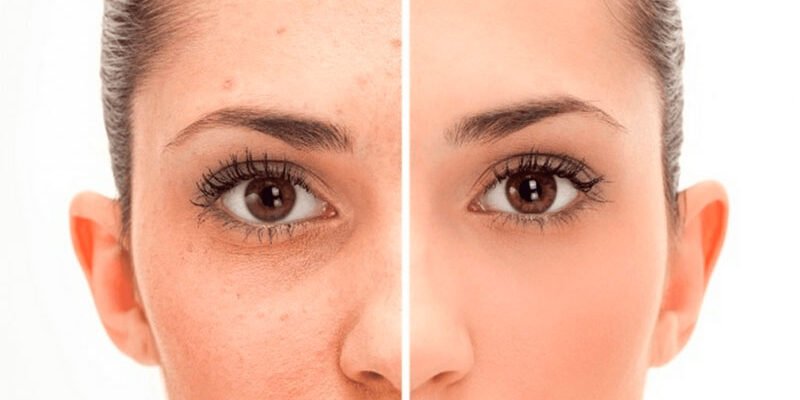 Ефективні методи позбавлення від шрамів після акне: поради та рекомендації