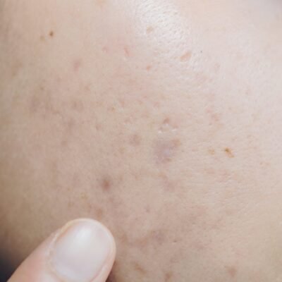 Ефективні методи позбавлення від слідів після прищів на шкірі