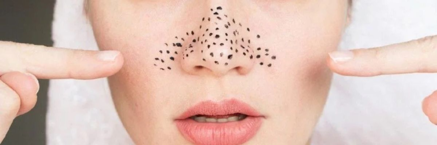 Ефективні методи усунення чорних цяток: поради для чистої шкіри