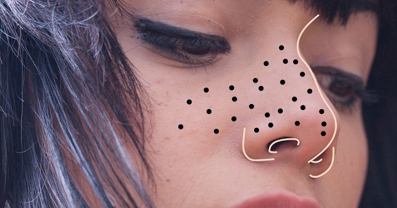 Як видалити чорні цятки в домашніх умовах - Kokl.Ua