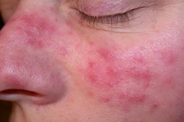 Ефективні народні засоби для боротьби з почервонінням обличчя вдома