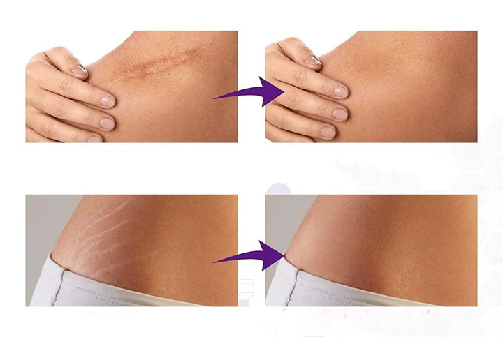 Cica-Care 12х6см Пластир від рубців і шрамів