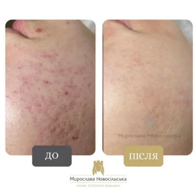 Ефективні способи лікування рубців від прищів: повернути гладку шкіру