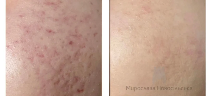 Ефективні способи лікування рубців від прищів: повернути гладку шкіру