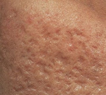 Видалення рубців на обличчі в Києві: лазерне видалення і ...