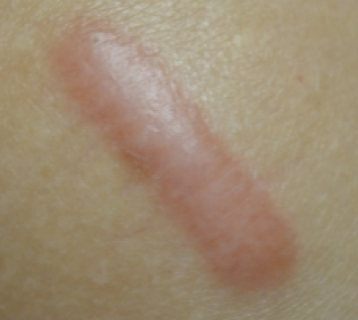 Видалення рубців на обличчі в Києві: лазерне видалення і ...