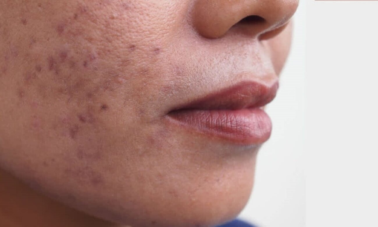 Процедури, які допоможуть прибрати сліди і шрами постакне — блог ...