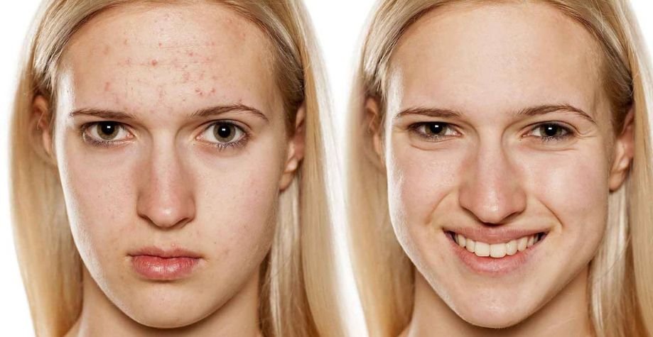 Як позбавитися від акне → Поради та рекомендації косметолога