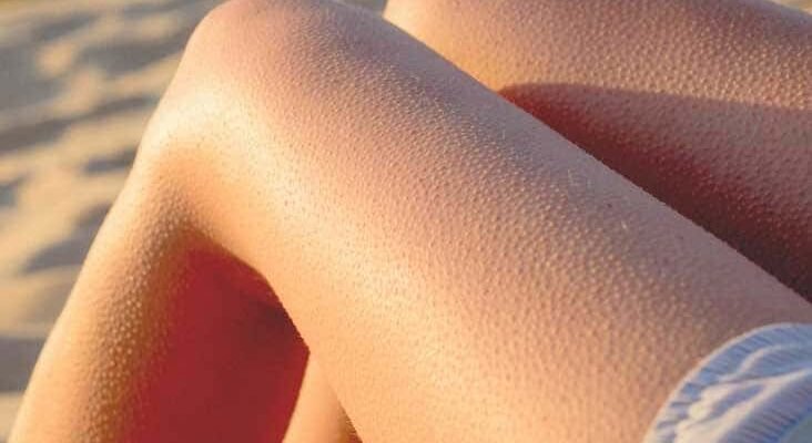 Ефективні засоби від гусячої шкіри: поради та рекомендації експертів