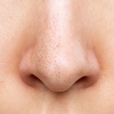 Ефективність саліцилової кислоти у боротьбі з чорними цятками на шкірі