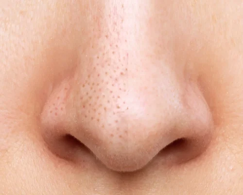 Ефективність саліцилової кислоти у боротьбі з чорними цятками на шкірі