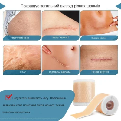Ефективний пластир від шрамів: Як обрати найкращий засіб для загоєння