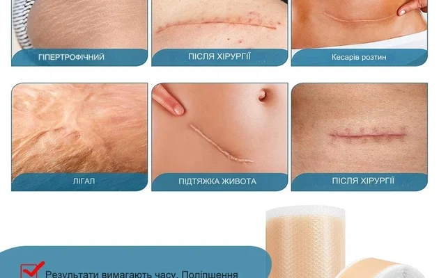 Ефективний пластир від шрамів: Як обрати найкращий засіб для загоєння