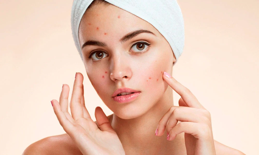 Лікування акне у Львові (вугрова хвороба) - Mediostar