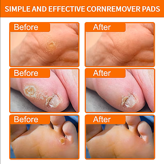 Пластир для видалення мозолів і натоптишів на ногах Eraycee (10 шт ...