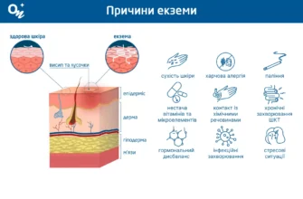 Екзема: основні причини виникнення та фактори ризику розвитку хвороби