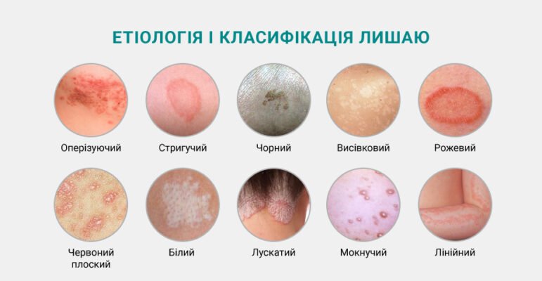 Лишай: як передається від людини до людини та як запобігти зараженню