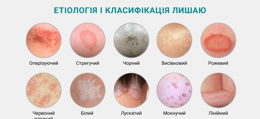 Лишай: як передається від людини до людини та як запобігти зараженню