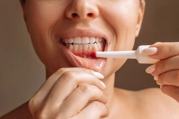 Найефективніший засіб від стоматиту: перевірені методи лікування