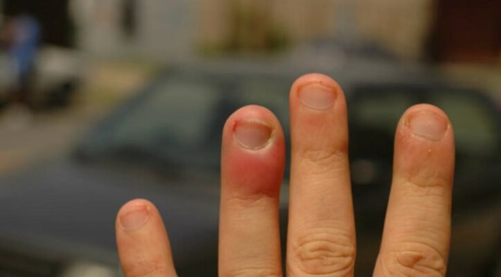 Опух палець на руці від удару: що робити та як зменшити біль?