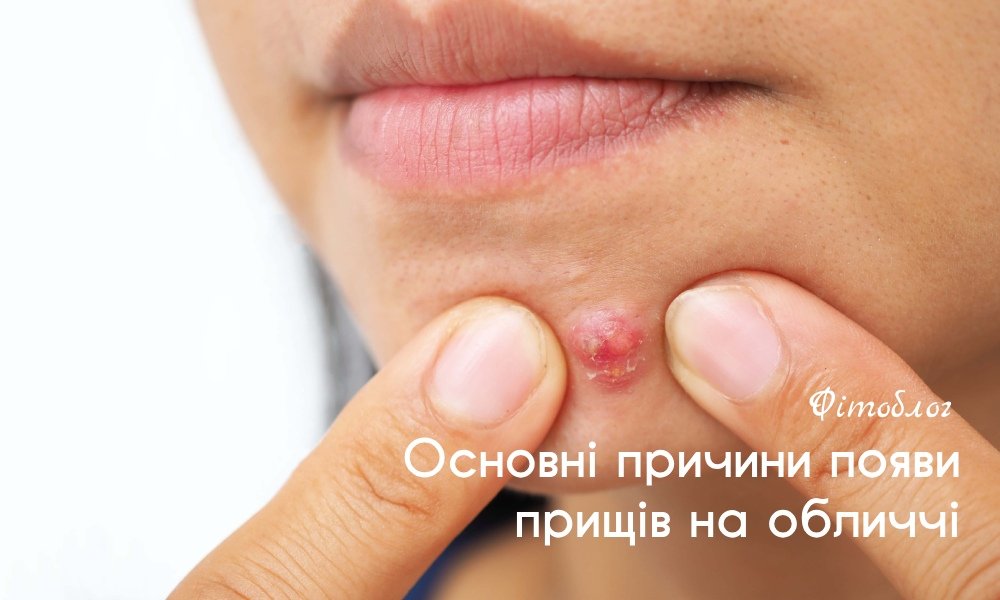 Прищі на обличчі: основні причини та як прибрати в домашніх умовах ...
