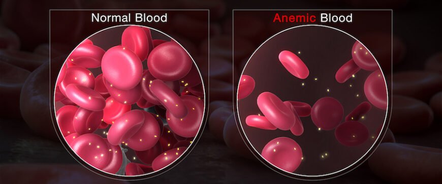 Основні причини зниження гемоглобіну: як уникнути нестачі заліза