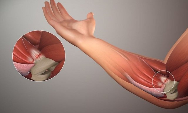 Неврит ліктьового нерву. Причини. Симптоми. Лікування