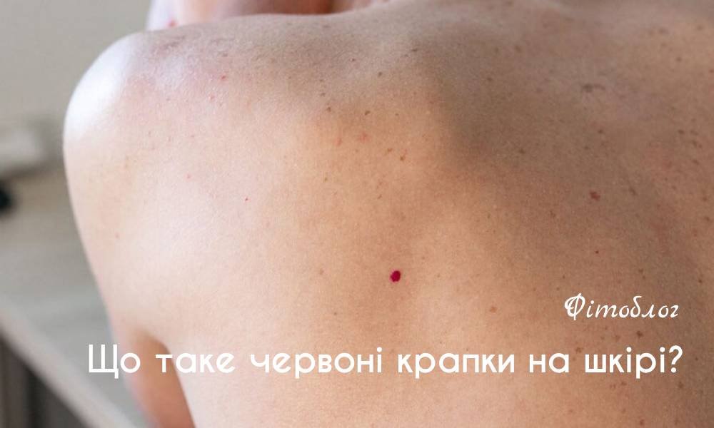 Червоні цятки на шкірі: можливі причини, симптоми, догляд - FitoBlog