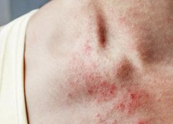 Плями на тілі від нервів: Причини, симптоми та методи лікування
