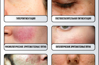 Поради для ефективного видалення плям від прищів в домашніх умовах