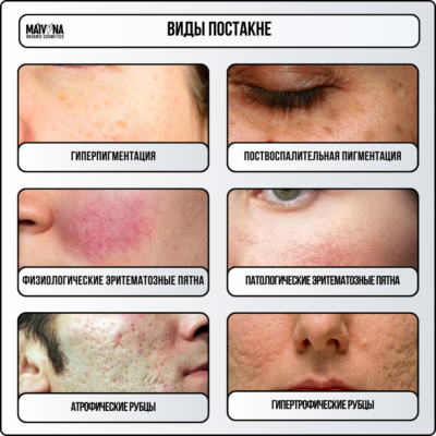 Поради для ефективного видалення плям від прищів в домашніх умовах