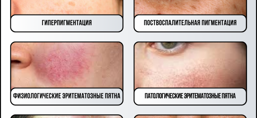 Поради для ефективного видалення плям від прищів в домашніх умовах