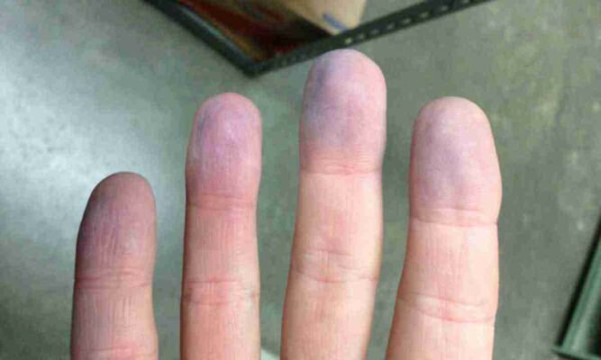 Посинів палець на руці від удару: причини та як швидко відновити