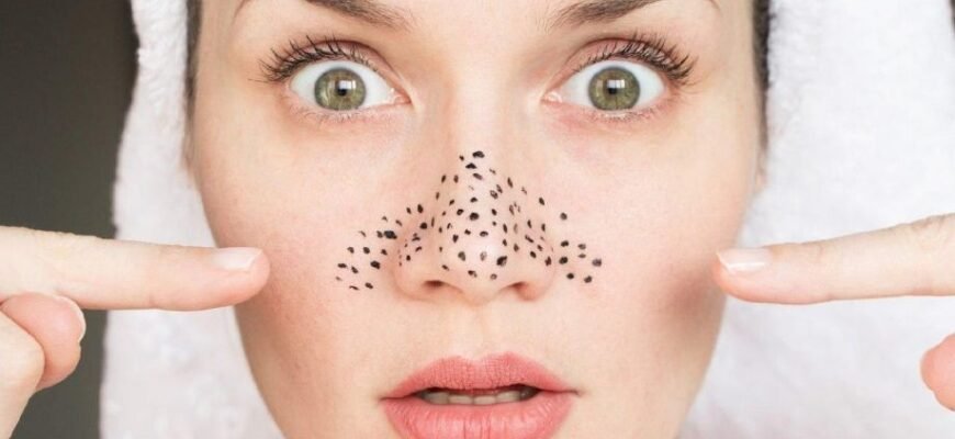 Позбавлення від чорних цяток на носі: ефективні методи та поради