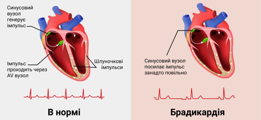 Причини брадикардії: від чого може уповільнюватися серцевий ритм