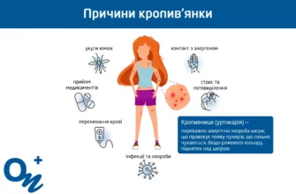 Причини кропив’янки: що викликає та як уникнути алергічних реакцій
