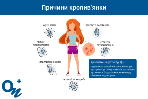 Причини кропив’янки: що викликає та як уникнути алергічних реакцій