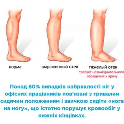 Причини набряків ніг: основні фактори та методи усунення набряклості