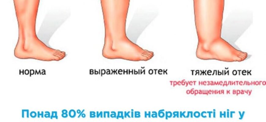Причини набряків ніг: основні фактори та методи усунення набряклості