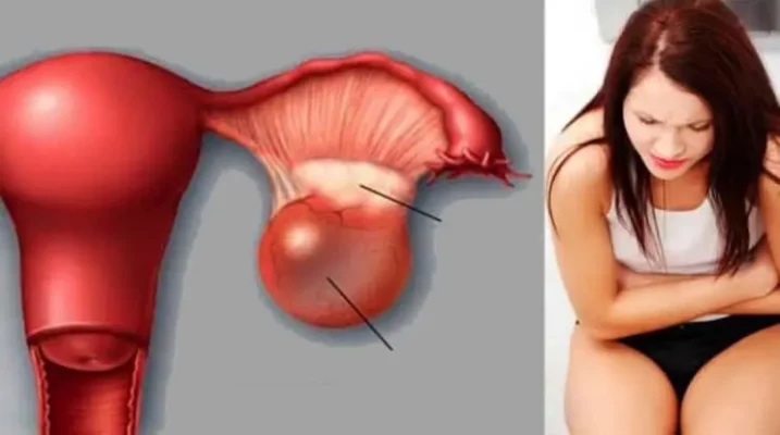 Причини перекруту яєчка: від чого виникає це небезпечне захворювання?