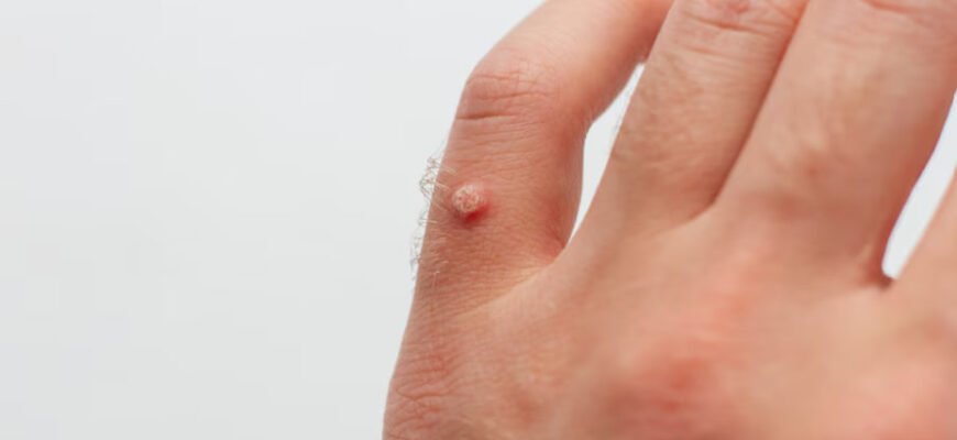 Причини появи бородавок на руках: основні фактори та профілактика