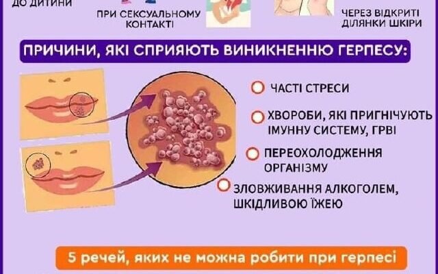 Причини появи герпесу на губах: основні фактори та профілактика