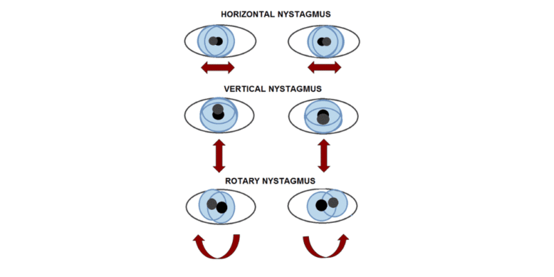 Причини появи катаракти: основні фактори та ризики захворювання