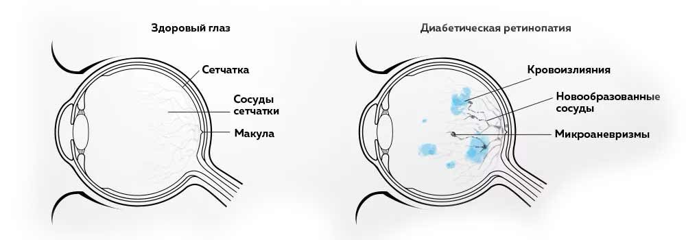Діабет і зір – Офтальмологічна кліника «Інститут зору»