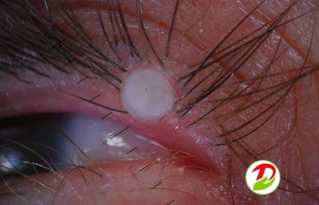 Причини появи міліумів: основні фактори та способи профілактики