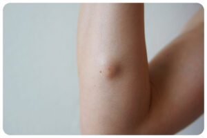 💙 💙 Жировик 💙 💙 Хірургічне видалення ліпоми (жировика) на ...