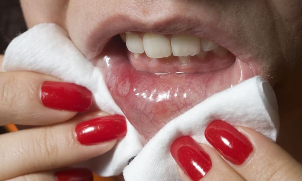 Стоматит - що це таке, фото, причини, симптоми та лікування ...